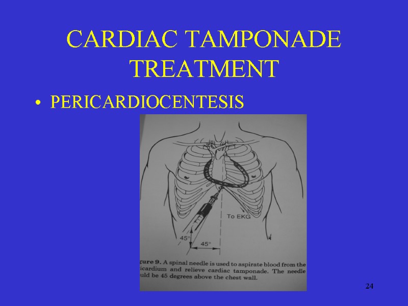 24 CARDIAC TAMPONADE TREATMENT PERICARDIOCENTESIS